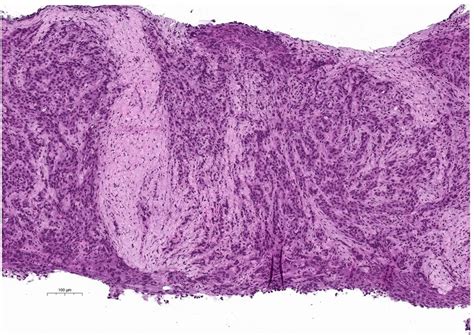 Non Lymphoid Malignant Proliferation In The Left Supraclavicular Lymph