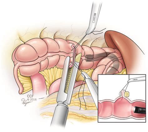 Laparoscopic Wedge Resection For The Removal Of The Ascending Colonic