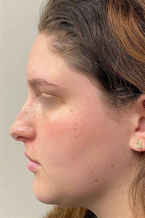 Los Angeles Rhinoplasty Before After Photos Patient 21 Dr Aminpour