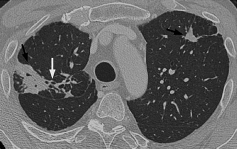 Figure 3 From Secuelas Y Complicaciones De La TBC Pulmonar Hallazgos