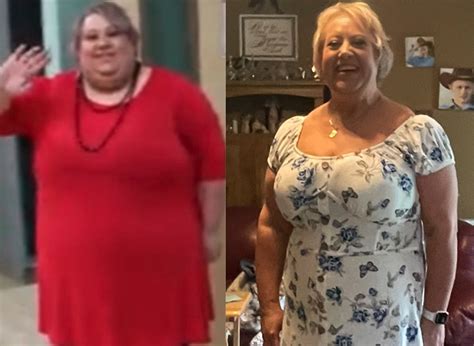 Felicia S Weight Loss Transformation St Louis Bariatrics