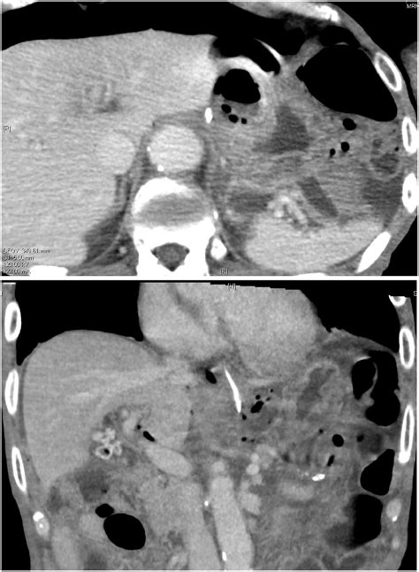 Abdominal Enhanced Ct Scan Abdominal Ct Scan Performed After Download Scientific Diagram