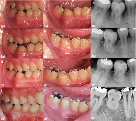 Post Operative Intraoral Photographs And Periapical Radiographs After