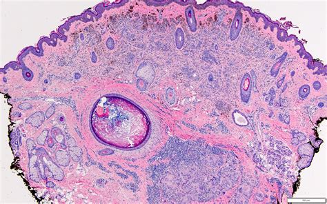 Benign Nevus Histology