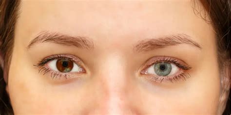 Heterochromia - American Academy of Ophthalmology