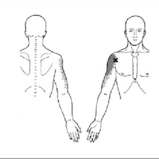 The Localization Of Trigger Points In The Infraspinatus Biceps Brachii