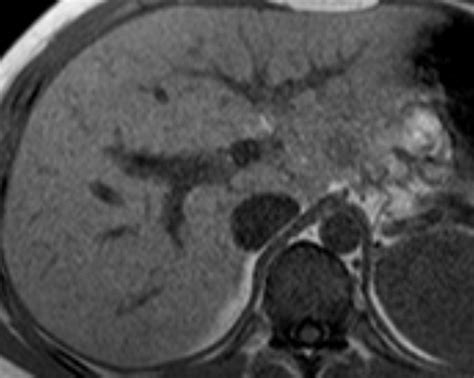 Liver Atlas Case 314 Wilsons Disease