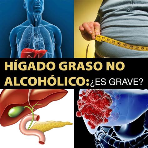 Hígado Graso No Alcohólico Guía Definitiva La Guía de las Vitaminas