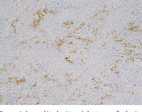 Figure 4 From A Case Of Uterine Lymphangioleiomyomatosis Complicated By