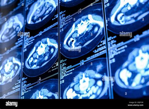 Computed Tomography Ct Scan Of Chest With Abdomen Stock Photo Alamy