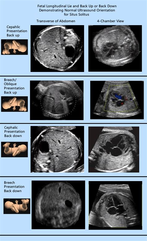 1final Normalsitus1 Obstetric Ultrasound Medical Ultrasound Ultrasound Technician