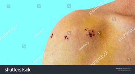 Male Shoulder Scars After Shoulder Arthroscope Stock Photo