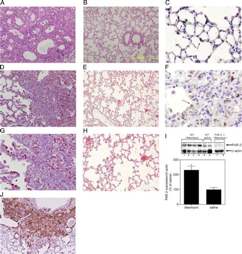 Protease Activated Receptor Induces Myofibroblast Differentiation And