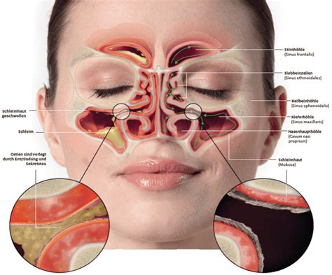 Nasennebenh Hlenentz Ndung Rhinosinusitis Symptome