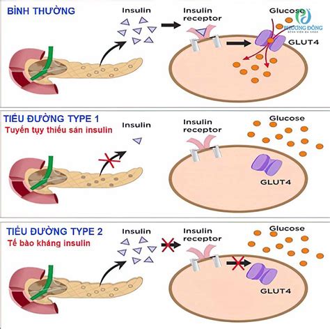 Đái Tháo đường Type 1 Nguyên Nhân Triệu Chứng Và Cách Chữa Trị