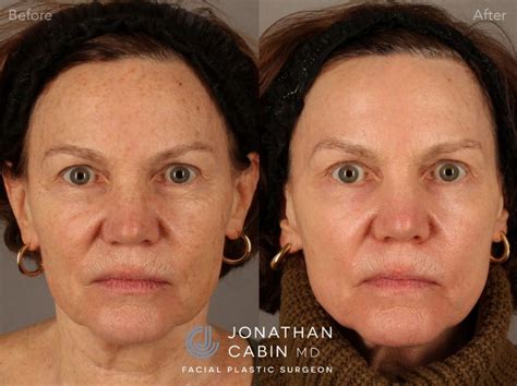 Laser Resurfacing Procedures Before And Afters Dr Jonathan Cabin