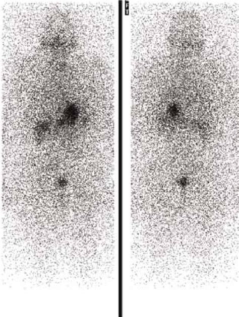 131 Post Thyrogen Whole Body Scan With 3mCi Show Minimal Uptake In The