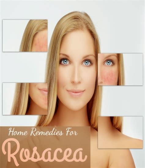 Home Remedies For Rosacea Tips Park