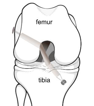 Anterior Cruciate Ligament Reconstruction KNEEguru