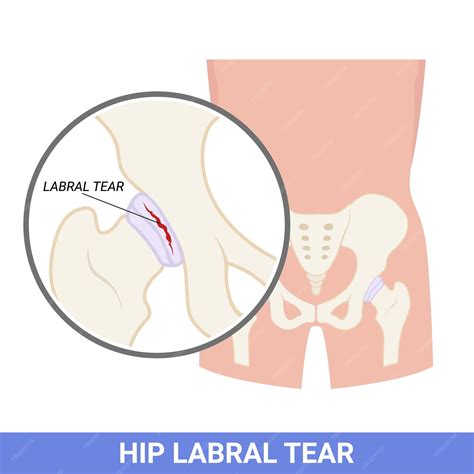 Premium Vector | The labral of hip that tear and injury the disorder in