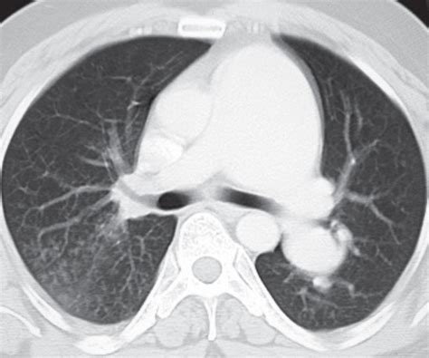 15 Pulmonic Stenosis Radiology Key