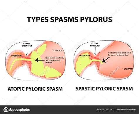 Rodzaje skurcze odźwiernika. Pylorospasm. Spastyczne i zwiotczałą ...