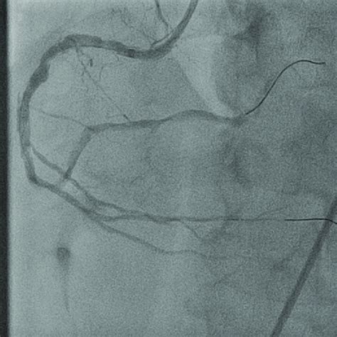 -Coronary angiogram -right coronary artery (RCA): two hydrophilic ...