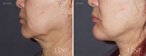 Gallery - Chin Implant - Line Plastic Surgery Center