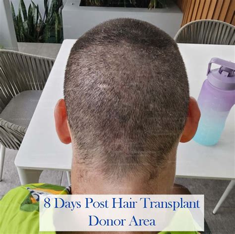 Hair Transplant In Turkey For An Aussie Diamond Hair Clinic Dr