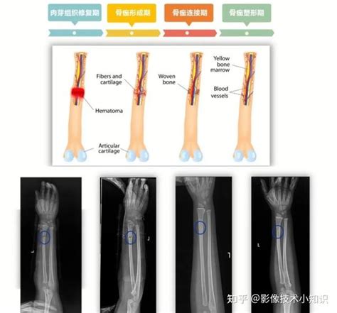 骨折影像表现（1） 知乎