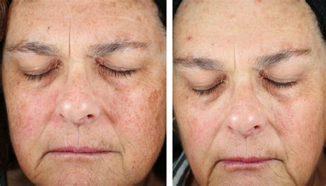 IPL Skin Rejuvenation - Sacramento, CA | Emil A. Tanghetti, MD