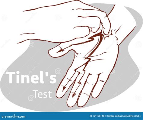 Vector Illustration of a Tinel`s Test Stock Vector - Illustration of ...