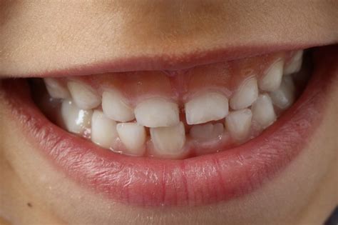 Prevenir caries dentales en niños Clínica Dental J Queraltó