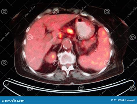 Medicina Nuclear De Pet/ct Fr1 Foto de archivo - Imagen de imágenes ...