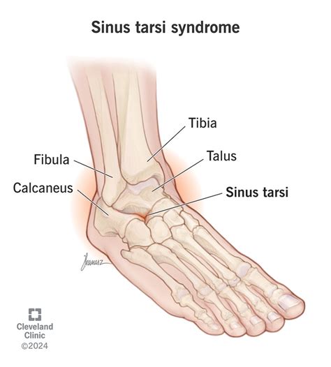 Sinus Tarsi Syndrome What It Is Symptoms Treatment