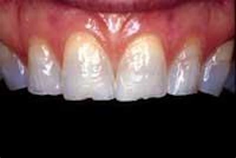 Modern ceramic veneer alternatives | Dental Economics