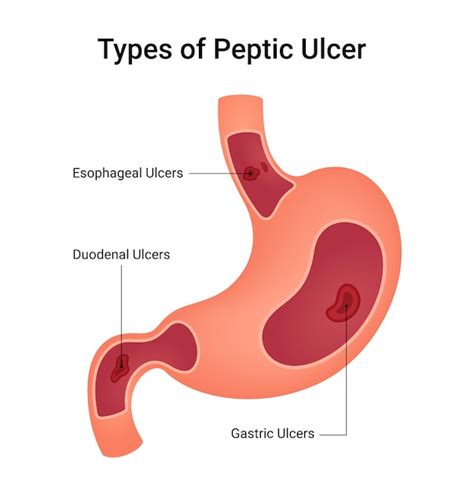 Tipos de úlcera péptica | Vetor Premium