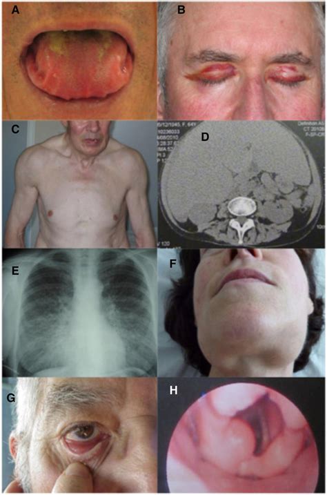 Amiloidose Concise Medical Knowledge