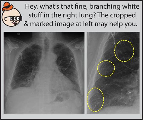 Stefan Tigges On Twitter RT StefanTigges Heres Another Chest X Ray