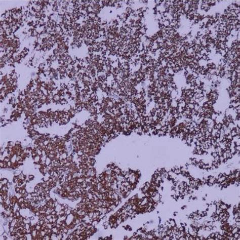 E Cadherin Positivity Tumor Cells Immunohistochemistry Staining