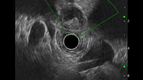 EUS Evaluation Using Radial And Linear Scopes For Suspected Gallbladder