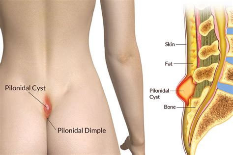 Advanced Solutions Pilonidal Cyst Colorectal Clinic Of Michigan