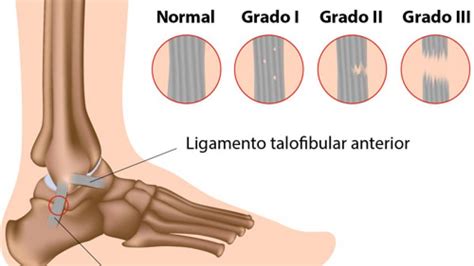 Todo Sobre Los Esguinces De Tobillo Grados Y Tratamiento OBELION P W