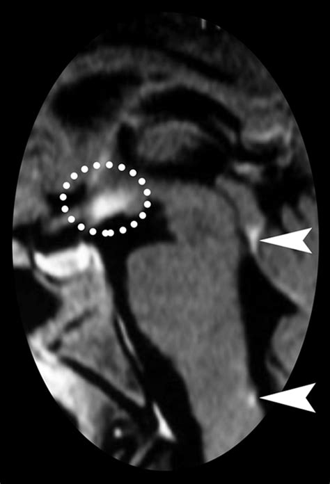 Neuromyelitis Optica Spectrum Disorders Spectrum Of Mr Imaging Findings And Their Differential