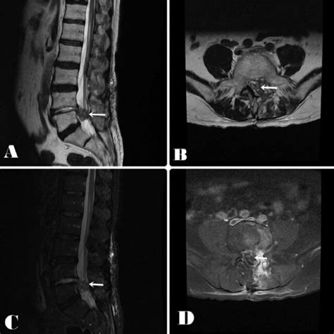 Mri Scans Showing Contrast Enhanced Mass Mri Magnetic Resonance