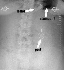 LAP BAND Diet : 6 Steps - Instructables