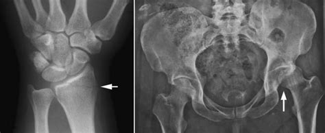 X-rays During Pregnancy - OrthoInfo - AAOS