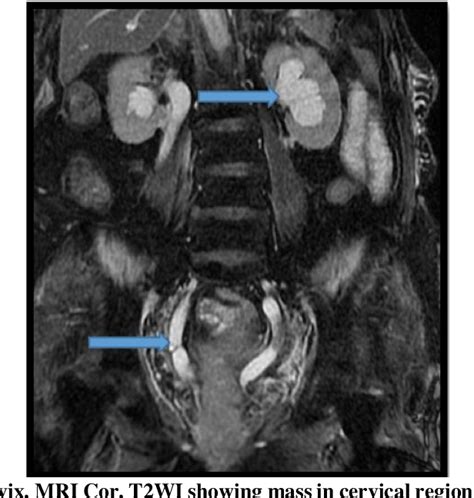 Assessment Of Hydronephrosis In Obstetrics And Gynaecology Patients