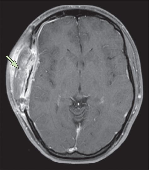 Epidural Abscesses Of The Cns The Lancet Neurology