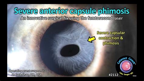 CataractCoach 2112 Severe Anterior Capsule Phimosis YouTube